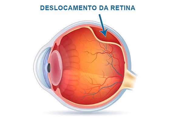 Doença da Retina