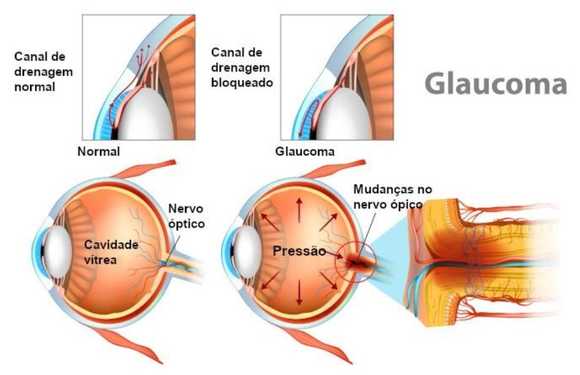 Imagem Glaucoma