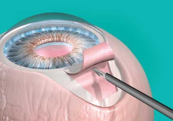 Cirurgia para tratamento do Glaucoma