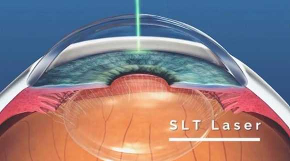 Tratamento a laser do Glaucoma – SLT